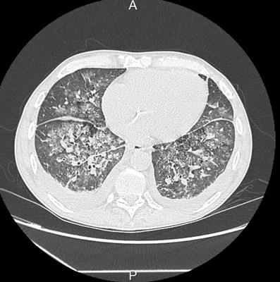 Rare manifestations of cryoglobulinemic vasculitis: a case report